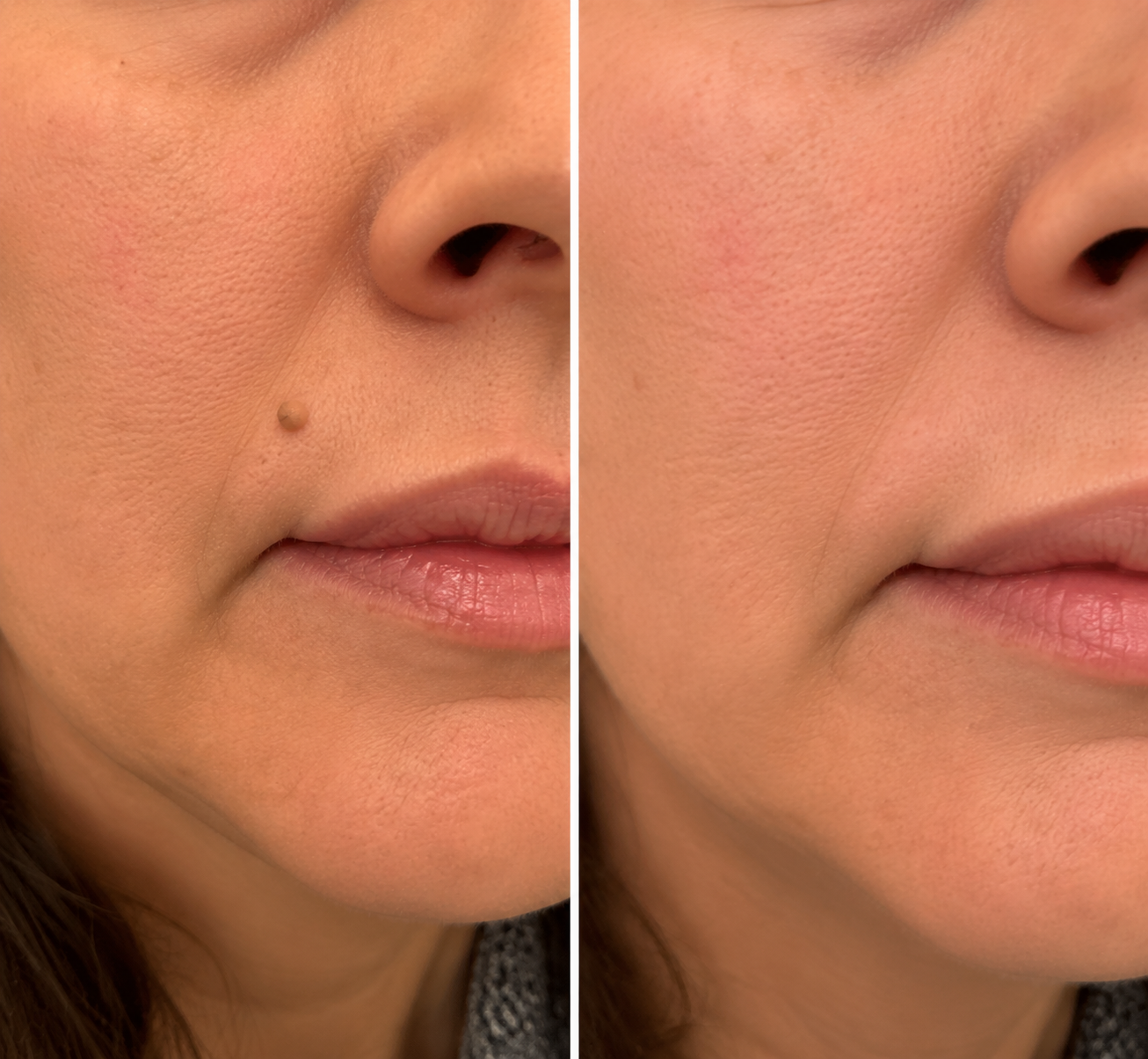 𝐏𝑬𝗔𝙍𝙇𝐌𝑶𝗢𝙉® 𝐏𝐚𝐭𝐜𝐡 𝐌𝐢𝐜𝐫𝐨𝐧𝐞𝐞𝐝𝐥𝐞 & 𝐇𝐲𝐝𝐫𝐨𝐜𝐨𝐥𝐥𝐨ï𝐝𝐞 𝟐-𝐞𝐧-𝟏🍀 | 𝐀𝐢𝐝𝐞 à é𝐥𝐢𝐦𝐢𝐧𝐞𝐫 𝐥'𝐚𝐜𝐧é, 𝐥𝐞𝐬 𝐯𝐞𝐫𝐫𝐮𝐞𝐬 𝐩𝐥𝐚𝐧𝐞𝐬 𝐞𝐭 𝐥𝐞𝐬 𝐚𝐜𝐫𝐨𝐜𝐡𝐨𝐫𝐝𝐨𝐧𝐬 | 𝐀𝐢𝐝𝐞 à 𝐚𝐭𝐭é𝐧𝐮𝐞𝐫 𝐥𝐞𝐬 𝐫𝐢𝐝𝐞𝐬, 𝐥𝐞𝐬 𝐜𝐢𝐜𝐚𝐭𝐫𝐢𝐜𝐞𝐬 𝐞𝐭 𝐥𝐞𝐬 𝐢𝐦𝐩𝐞𝐫𝐟𝐞𝐜𝐭𝐢𝐨𝐧𝐬 | 𝐏𝐚𝐭𝐜𝐡𝐬 𝐢𝐧𝐯𝐢𝐬𝐢𝐛𝐥𝐞𝐬 𝐩𝐨𝐮𝐫 𝐥𝐞 𝐯𝐢𝐬𝐚𝐠𝐞 𝐞𝐭 𝐥𝐞 𝐜𝐨𝐫𝐩𝐬
